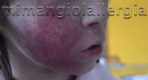 Viso arrossato by mimangiolallergia